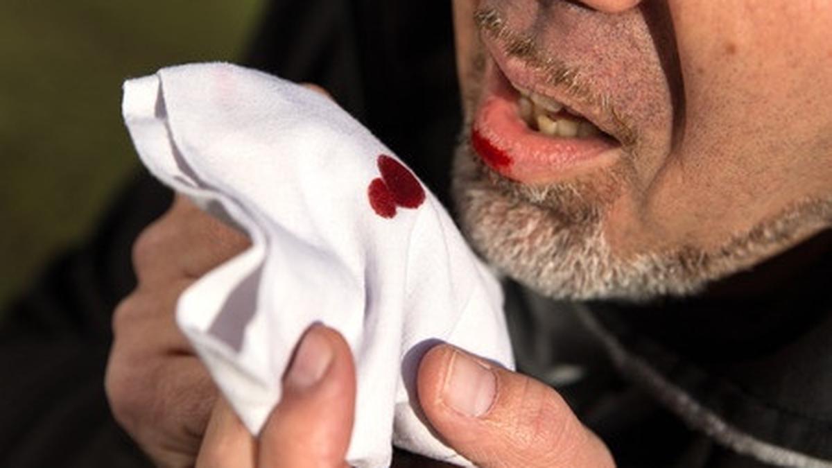 Faktor Risiko Batuk Berdarah Dari Infeksi Hingga Penyakit Kronis