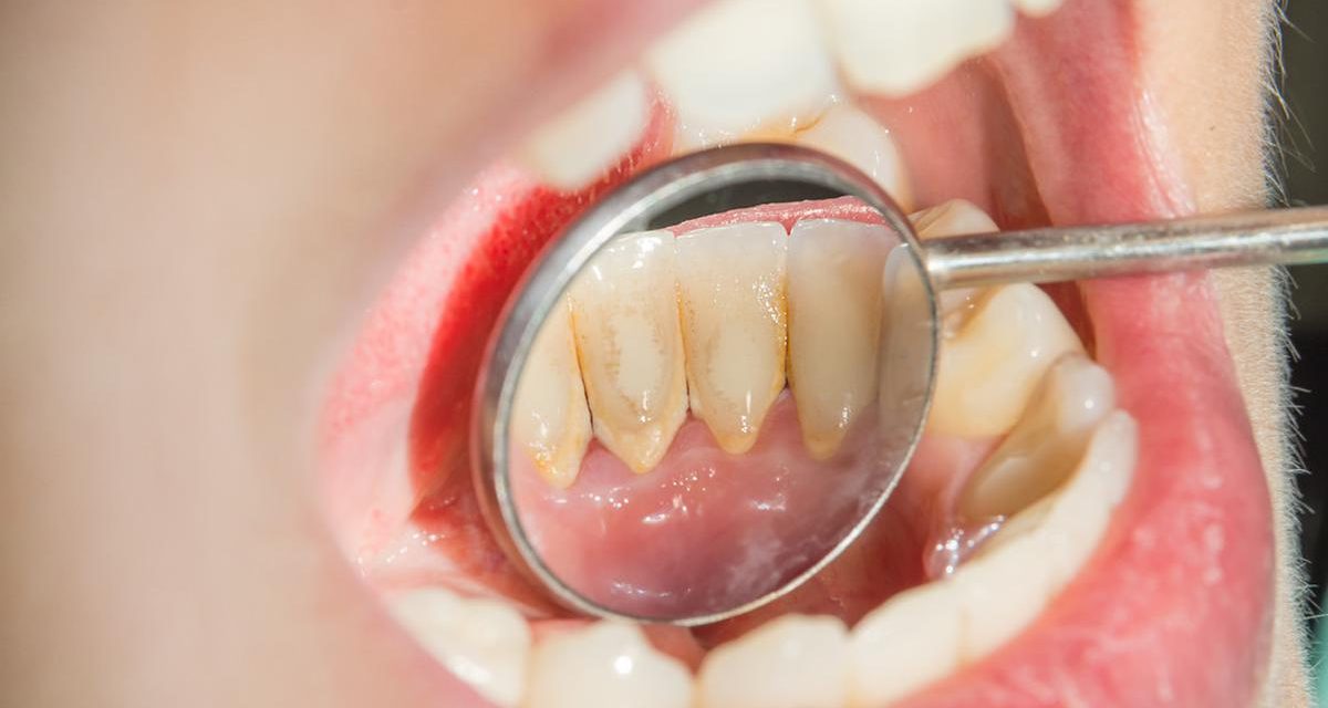 Kebiasaan Yang Memicu Munculnya Karang Gigi Sehari-Hari