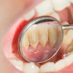 Kebiasaan Yang Memicu Munculnya Karang Gigi Sehari-Hari