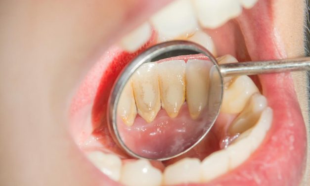 Kebiasaan Yang Memicu Munculnya Karang Gigi Sehari-Hari