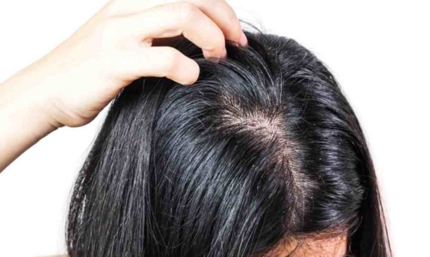 Penyebab Rambut Berminyak Dan Cara Mengatasinya